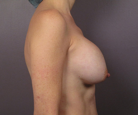 Breast Implant Correction before and after photo