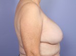 Breast Implant Correction Before and after photo