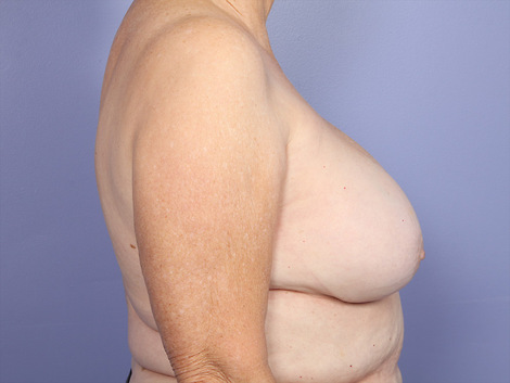 Breast Implant Correction before and after photo