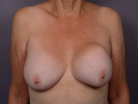 Breast Implant Correction before and after photo