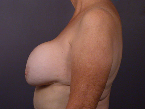 Breast Implant Correction before and after photo