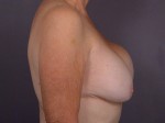 Breast Implant Correction Before and after photo