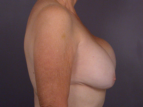 Breast Implant Correction before and after photo