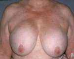 Breast Implant Correction Before and after photo