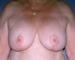 Breast Implant Correction Before and after photo