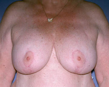 Breast Implant Correction before and after photo