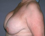 Breast Implant Correction Before and after photo