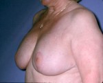Breast Implant Correction Before and after photo