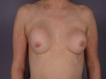 Breast Implant Correction