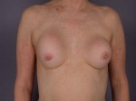 Breast Implant Correction Before and after photo