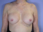 Breast Implant Correction Before and after photo