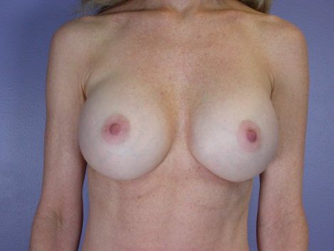 Breast Implant Correction before and after photo