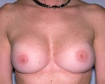 Breast Implant Correction Before and after photo