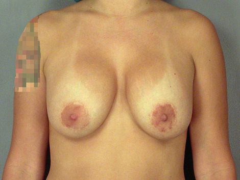 Breast Implant Correction before and after photo