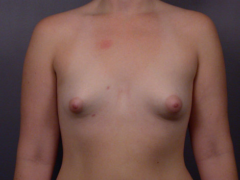 Breast Implant Correction before and after photo