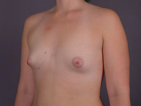 Breast Implant Correction before and after photo