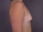 Breast Implant Correction Before and after photo