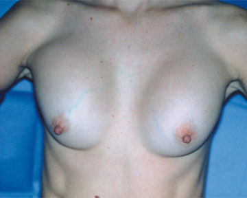 Breast Implant Correction before and after photo