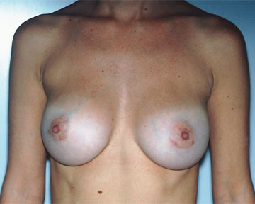 Breast Implant Correction before and after photo