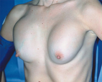 Breast Implant Correction before and after photo