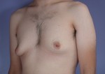 Breast Reduction (for Men) Before and after photo