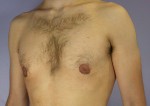 Breast Reduction (for Men) Before and after photo