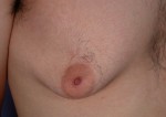 Breast Reduction (for Men) Before and after photo