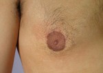 Breast Reduction (for Men) Before and after photo