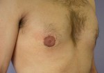 Breast Reduction (for Men) Before and after photo