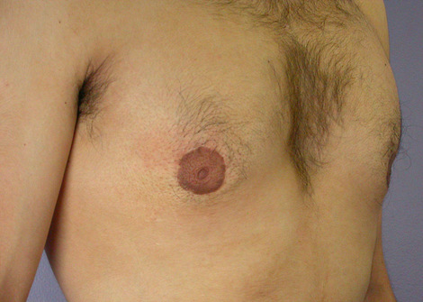 Breast Reduction (for Men) before and after photo