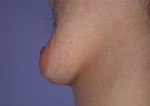 Breast Reduction (for Men) Before and after photo