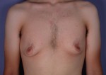 Breast Reduction (for Men)