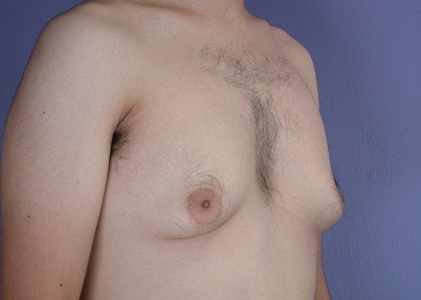 Breast Reduction (for Men) before and after photo