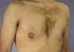 Breast Reduction (for Men) Before and after photo