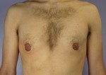 Breast Reduction (for Men)