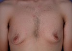 Breast Reduction (for Men) Before and after photo