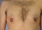 Breast Reduction (for Men)