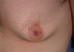 Breast Reduction (for Men) Before and after photo