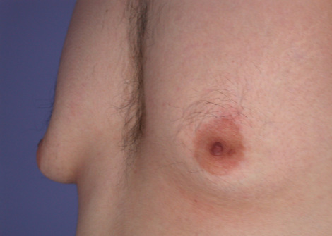 Breast Reduction (for Men) before and after photo