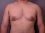 Breast Reduction (for Men)