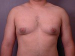 Breast Reduction (for Men) Before and after photo