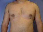 Breast Reduction (for Men) Before and after photo