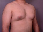 Breast Reduction (for Men)