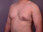 Breast Reduction (for Men) Before and after photo