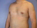 Breast Reduction (for Men) Before and after photo