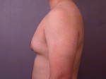 Breast Reduction (for Men) Before and after photo