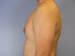 Breast Reduction (for Men) Before and after photo