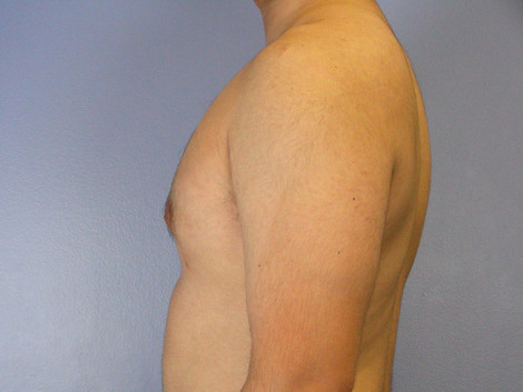 Breast Reduction (for Men) before and after photo