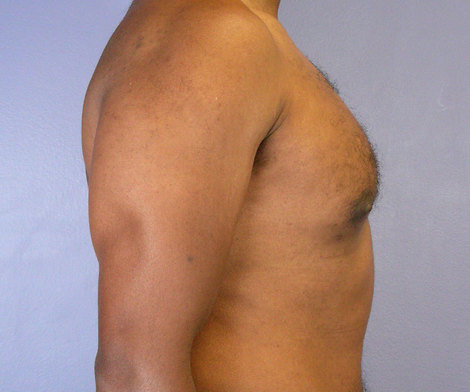 Breast Reduction (for Men) before and after photo