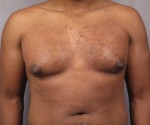 Breast Reduction (for Men) Before and after photo